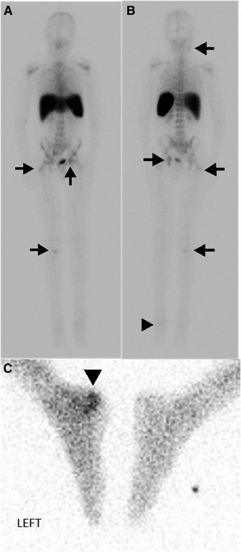 White Blood Scan Fr 99mTc-HMPAO–Labeled WBC Scan for the Diagnosis of Chronic Recurrent