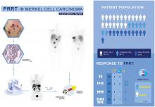 Peptide Receptor Radionuclide Therapy in Merkel Cell Carcinoma: A Comprehensive Review