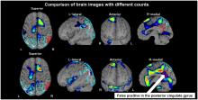 Influence of Minimum Count in Brain Perfusion SPECT: Phantom and Clinical Studies