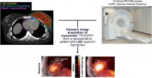 PET/MRI Assessment of Acute Cardiac Inflammation 1 Month After Left-Sided Breast Cancer Radiation Therapy