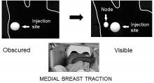 A Practical Technique to Improve Visualization of Sentinel Nodes in the Axillary Region on Breast Lymphoscintigraphy: Medial Breast Traction by Patient