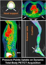 Blanching Defects at Pressure Points: Observations from Dynamic Total-Body PET/CT Studies