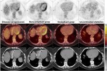 PET/CT Case Series: Unmasking the Mystery of Cardiac Sarcoidosis